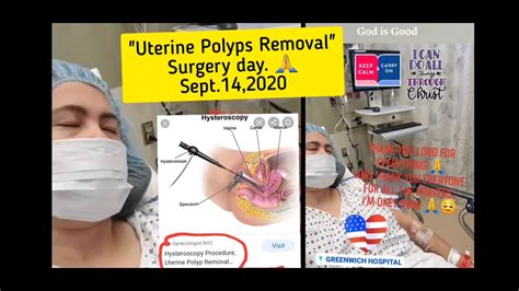 Page last reviewed August 30, 2022. . Successful stories after uterine polyp removal